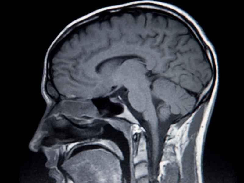An example of an MRI scan of the brain.